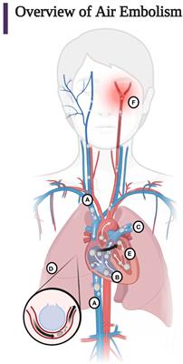 Iatrogenic air embolism: pathoanatomy, thromboinflammation, endotheliopathy, and therapies